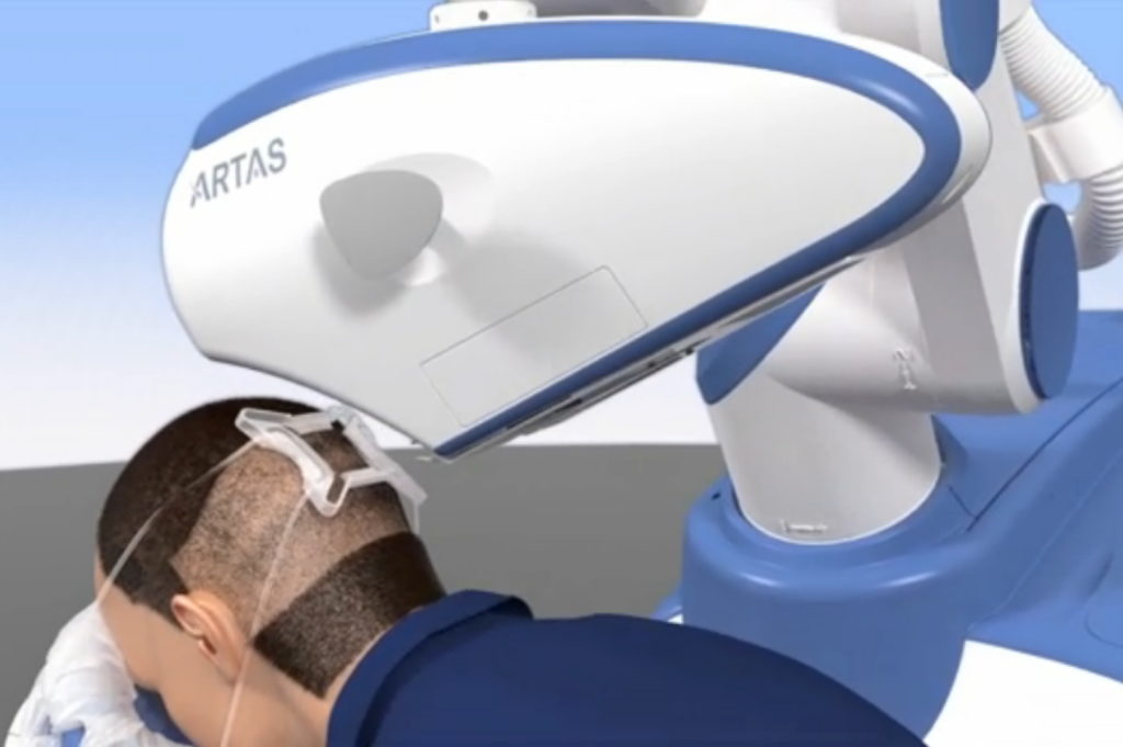 ARTAS ROBOTIC TRANSPLANT | ARTAS ROBOTIC TRANSPLANT |