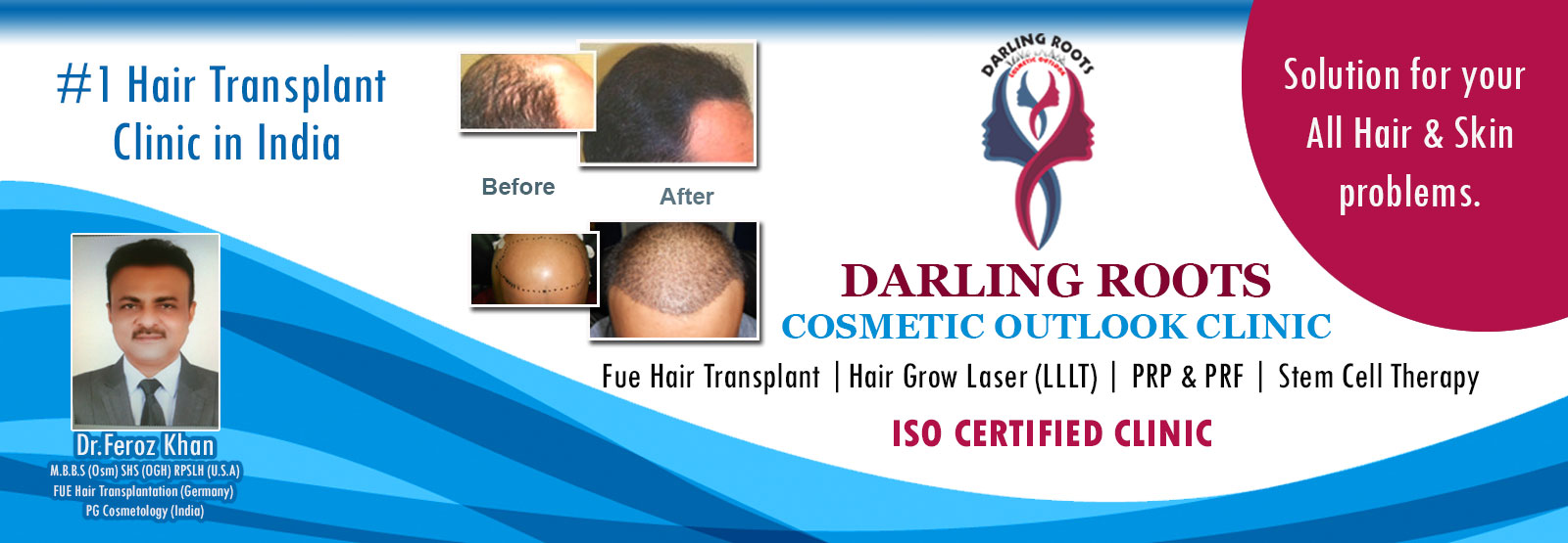 Best FUE Hair Transplant Clinic in Hyderabad | Darling Roots Best FUE Hair Transplant Clinic in Hyderabad | Darling Roots