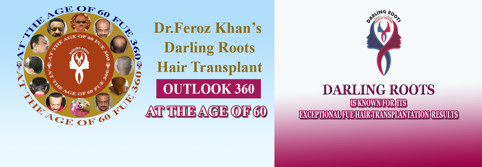 Best FUE Hair Transplant Clinic in Hyderabad | Darling Roots Best FUE Hair Transplant Clinic in Hyderabad | Darling Roots